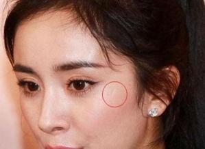 有瘢痕疙瘩的明星,揭秘他们与疤痕共舞的故事